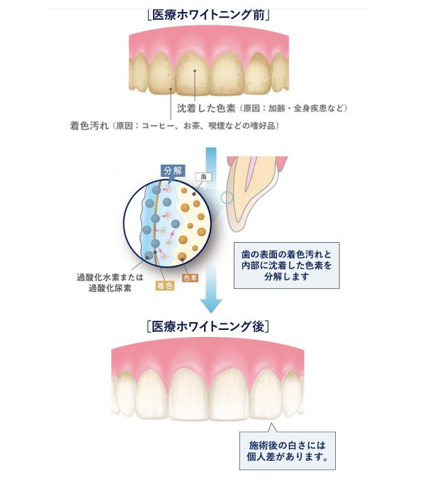 ホワイトバンドはホワイトニングを継続することで目立たなくなります。